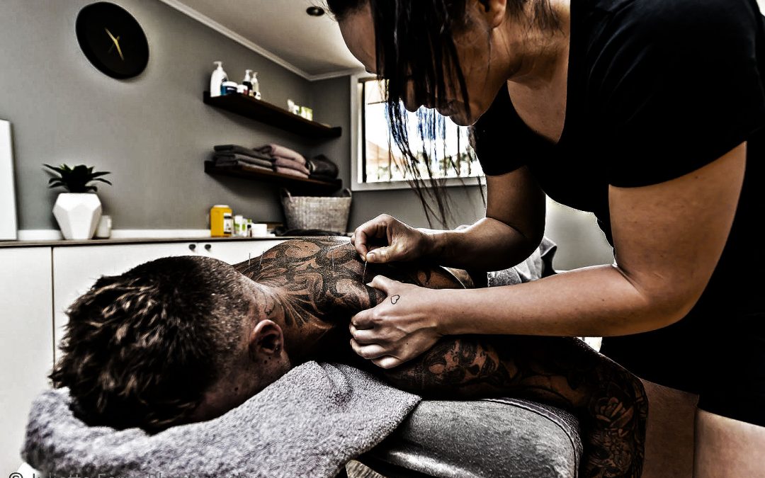 DRY NEEDLING …EVERYTHING YOU NEED TO KNOW